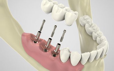 Dental Implants